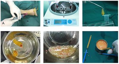 Platelet-Rich Fibrin in Fat Grafts for Facial Lipofilling: A Randomized, Controlled Split-Face Clinical Trial